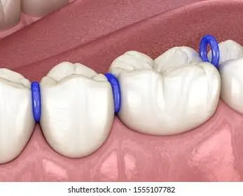 Rubber Separator 